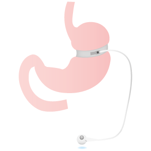 schéma anneau gastrique gastroplastie