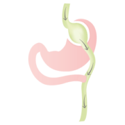 schéma bypass gastrique