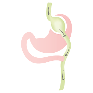 schéma bypass gastrique