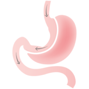 schéma sleeve gastrectomie